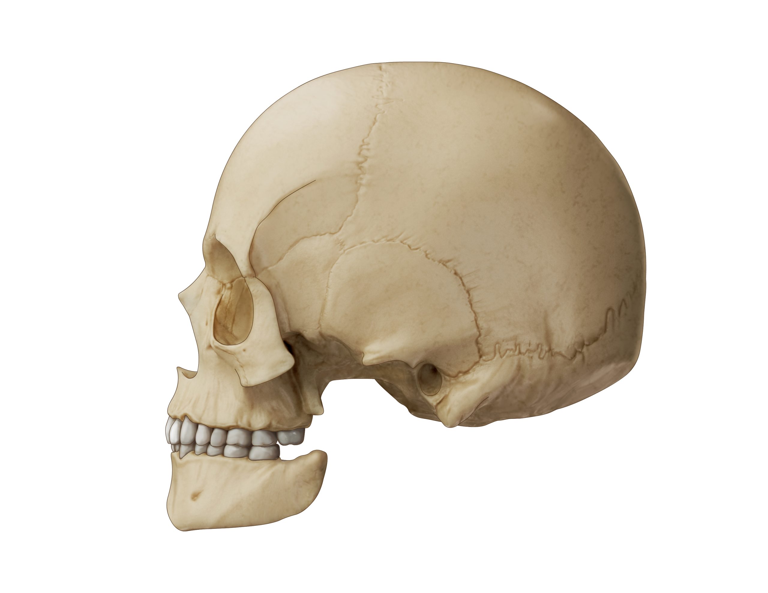 Illustration of hemifacial microsomia with a type 3 mandible.