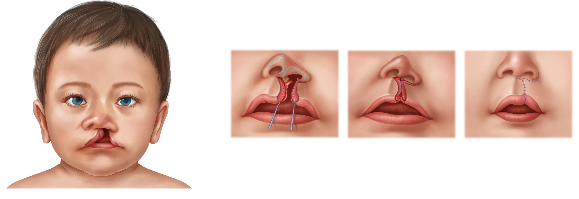 Unilateral Cleft Lip Repair - 2 Unilateral cleft lip repair illustration