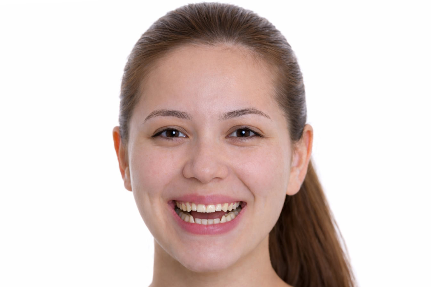 anterior-openbite-frontal-3
