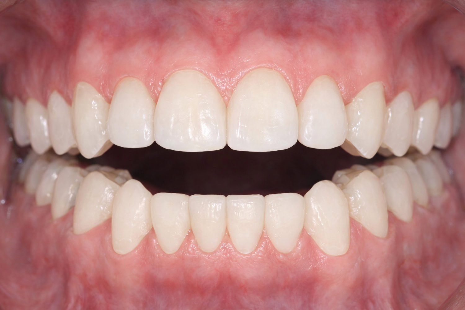 anterior-openbite-occlusal