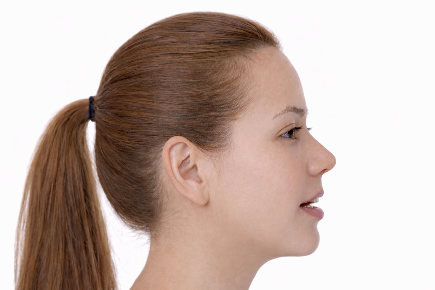 anterior-openbite-profile-2