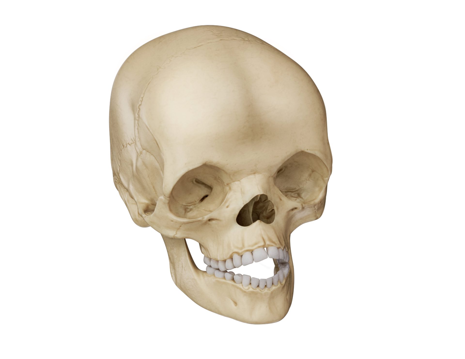 Illustration of craniofacial features of Apert syndrome.