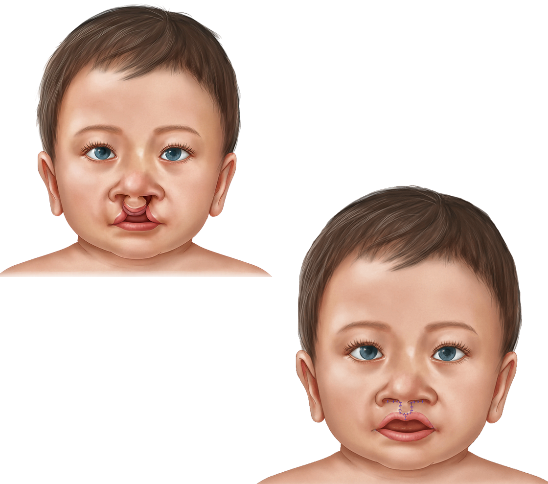 Before and after illustration of bilateral cleft lip repair.