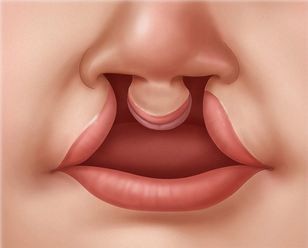 Bilateral-Cleft-Lip-Repair-step-1v2 Illustration of a two-sided cleft lip before surgical repair.
