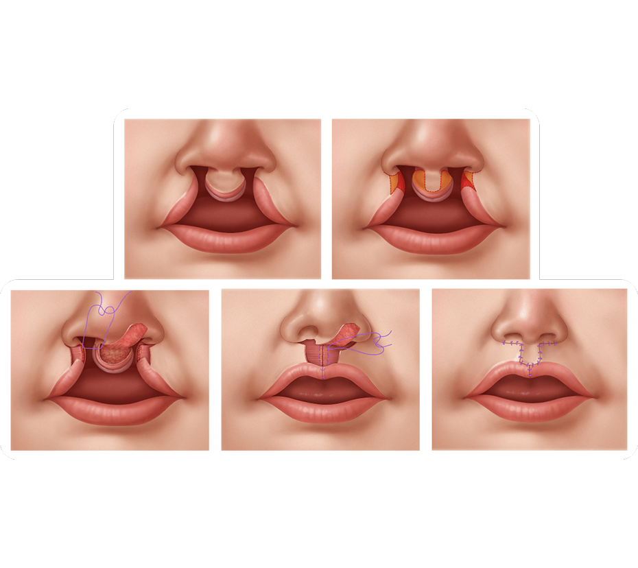 Illustration of a bilateral cleft lip.