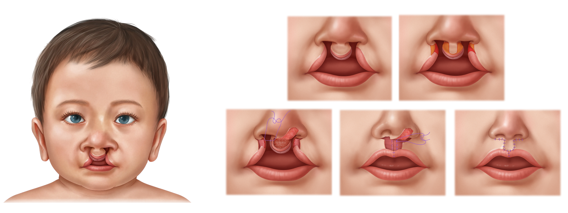 Bilateral Cleft Lip Repair - 2 Bilateral cleft lip repair illustration