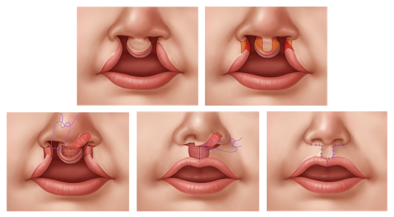 Illustration of a bilateral cleft lip repair.