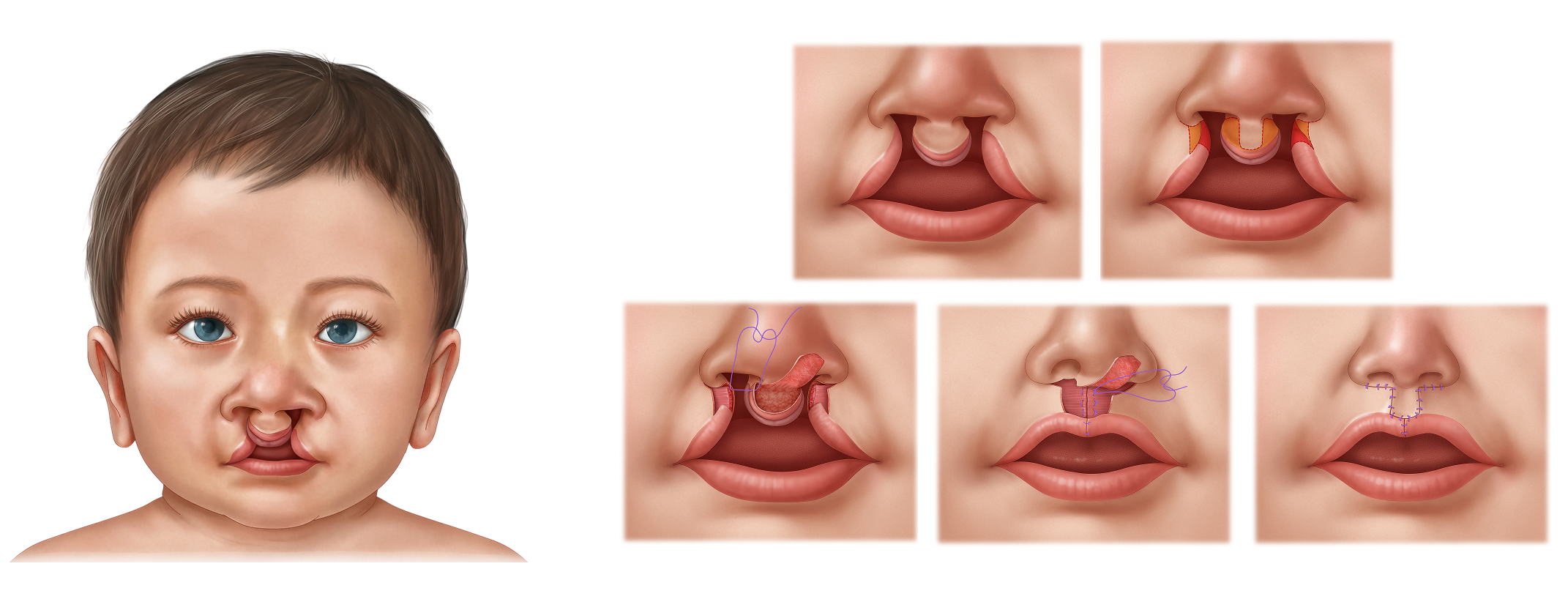 Bilateral Cleft Lip Repair