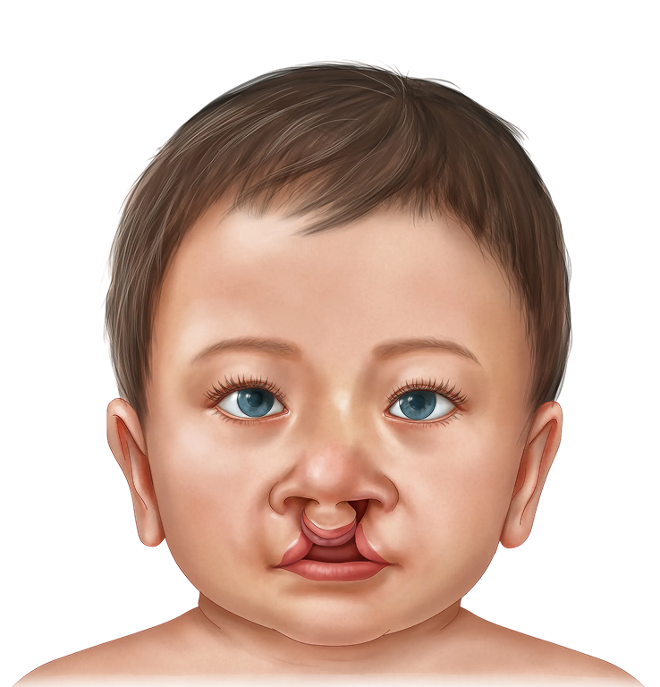 Bilateral Complete Cleft Lip Illustration