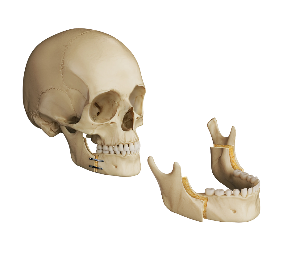 BSSO Surgical Illustration