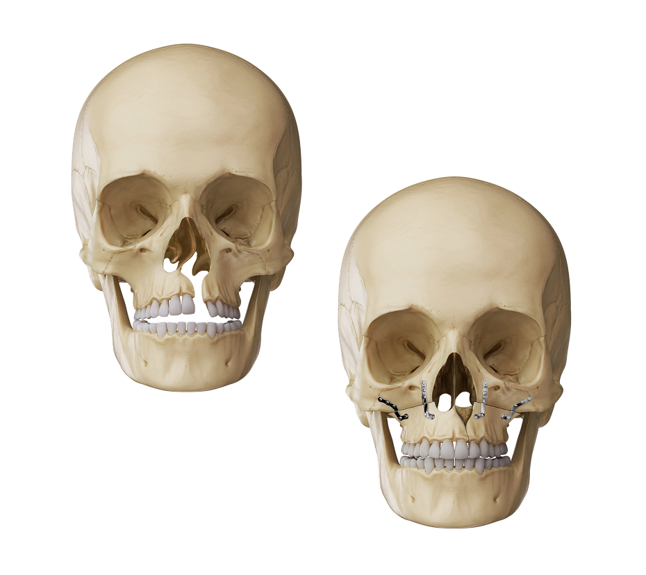 Cleft Le Fort I Osteotomy Illustration