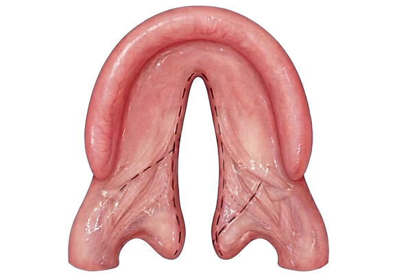 Close-up of a surgical repair on a cleft palate in a patient.