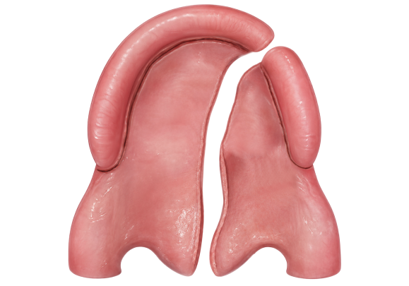 bardach 1 - reframed - wide Illustration of a complete cleft of the hard and soft palate before Bardach two flap repair.