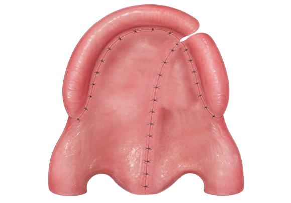 bardach 6 - reframed - wide Illustration of the completed Bardach two flap palate repair with the midline suture line visible.