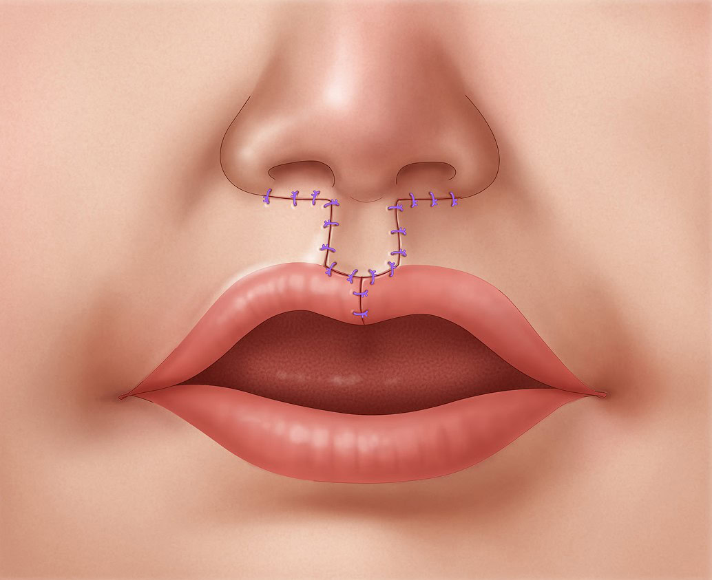 Bilateral-Cleft-Lip-Repair-step-5v2 Illustration of the completed suture line in bilateral cleft lip repair.