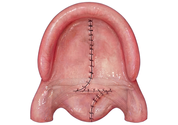 cleft palate step 5 Illustration of the completed Z-plasty closure lengthening the soft palate in Furlow palatoplasty.