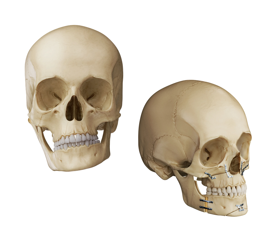 Condylar Hyperplasia Surgery Illustration