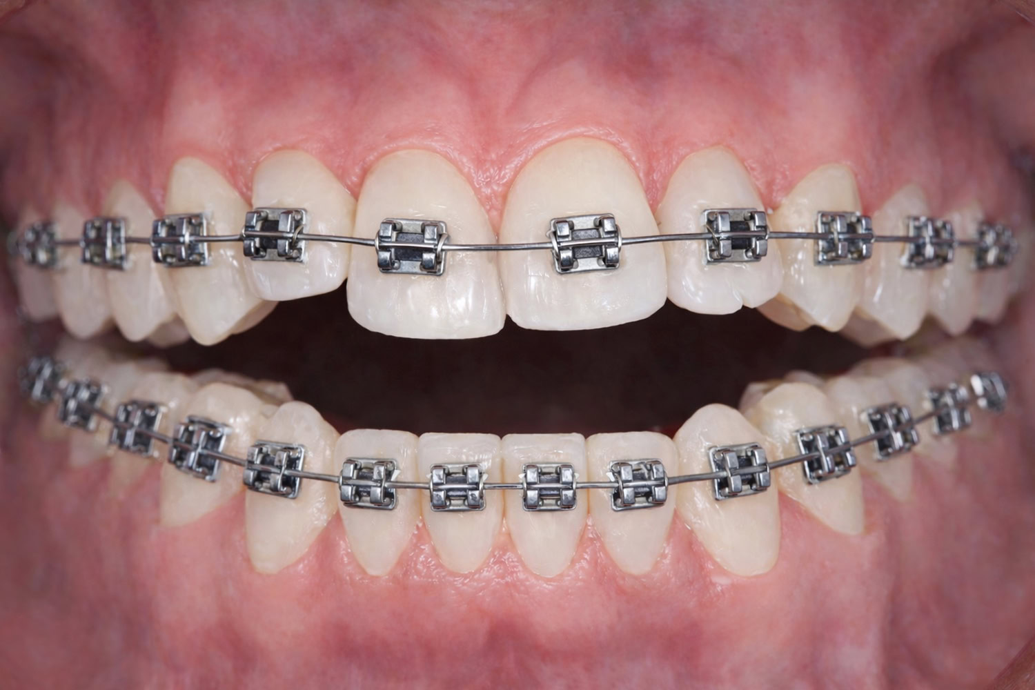 condylar-resorption-occlusal-3 Clinical presentation of condylar resorption, occlusal view.