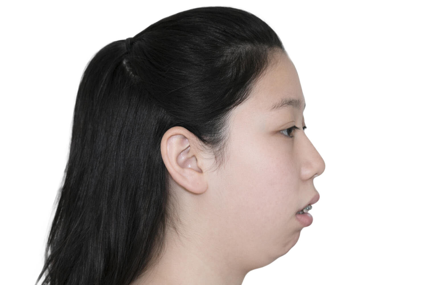 condylar-resorption-profile-v2-scaled Clinical presentation of condylar resorption, profile view.