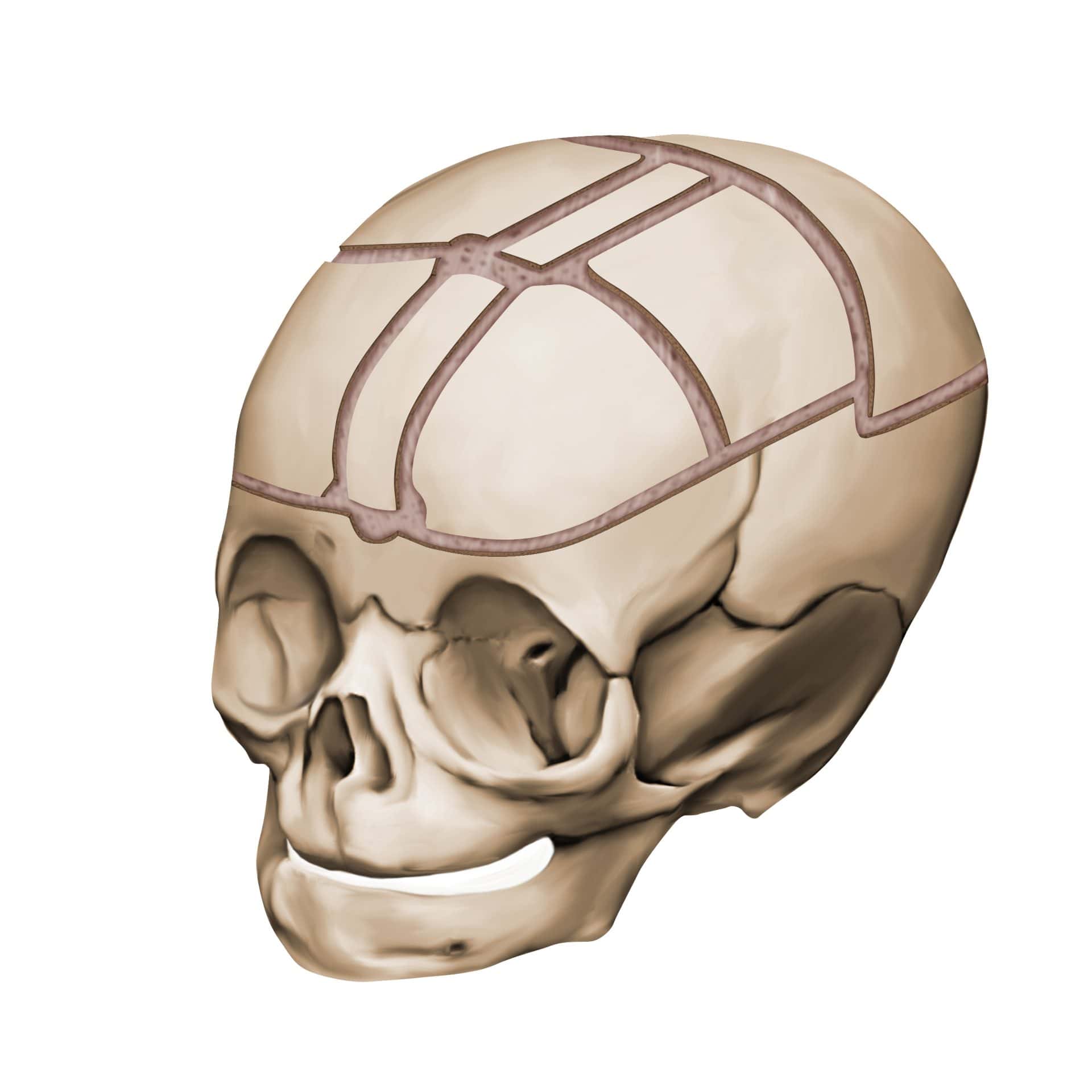 Illustration of cranial vault remodeling reshaping the skull.