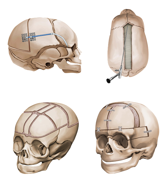 Illustration of cranial vault reshaping techniques for craniosynostosis in children.