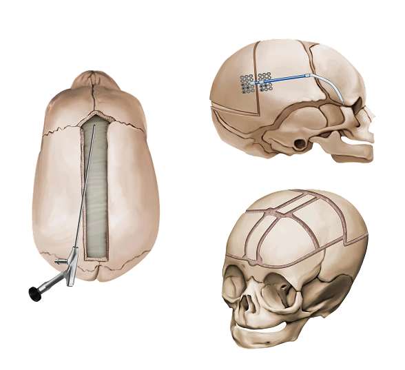 Craniosynostosis Surgical Repair techniques.webp