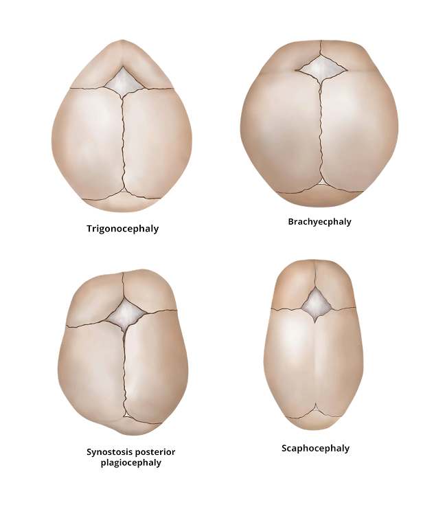 Comparison of skull shapes in craniosynostosis with different suture closures.