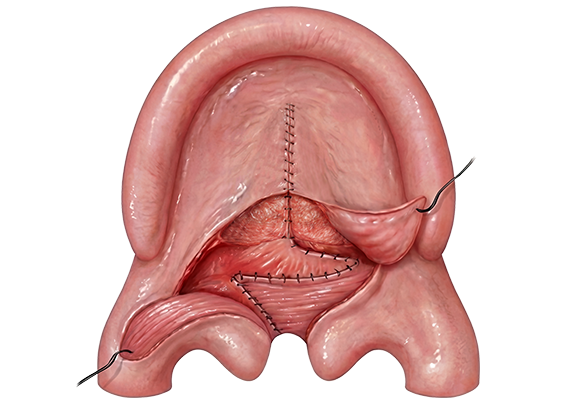cleft palate step 4 Deep Flaps Transposed Across the Cleft and mucosa closing- Furlow Palatoplasty