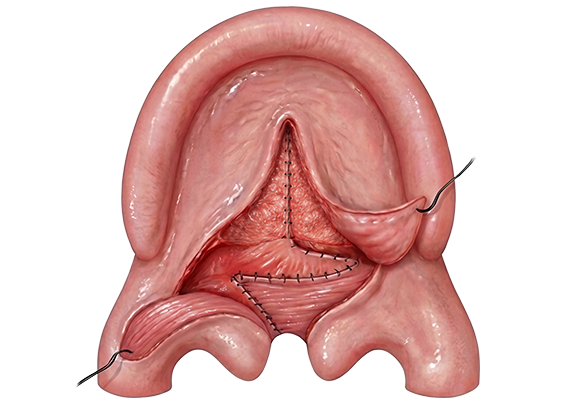 cleft palate step 3.1 Deep Z-plasty Flaps Transposed Across the Cleft - Furlow Palatoplasty