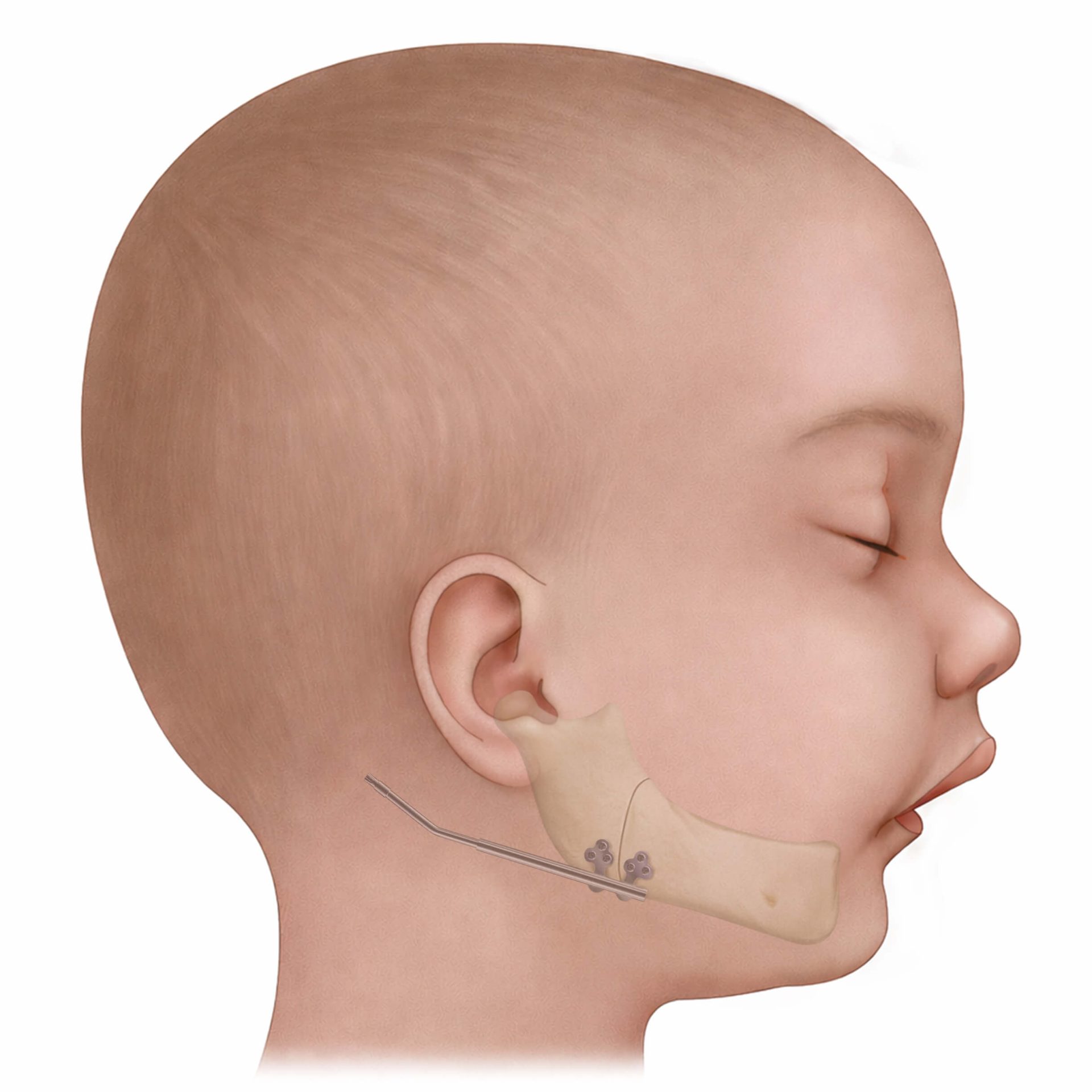 PRS_2-edited-scaled Illustration of a mandibular distraction device placed on the infant jaw in Pierre Robin Sequence treatment.