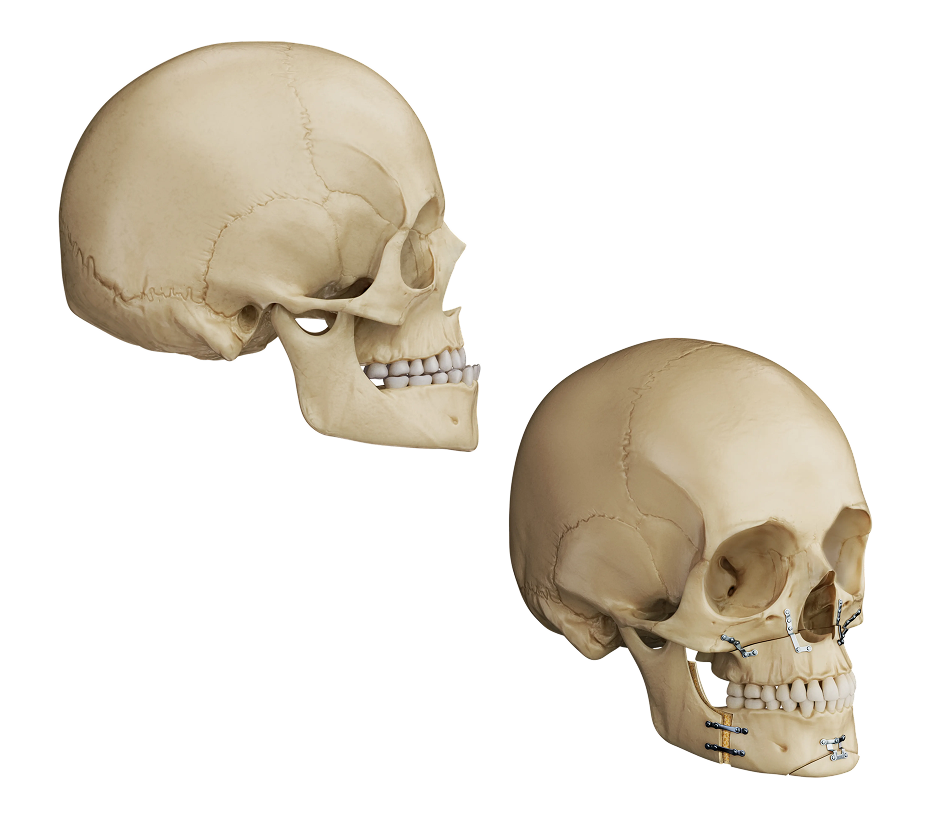 Double Jaw Surgery Illustration (2)