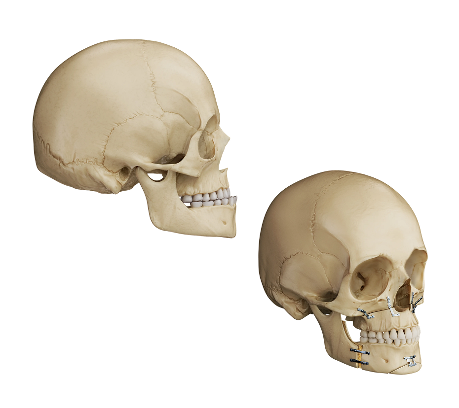 Two skull models illustrating craniofacial abnormalities in Crouzon Syndrome.