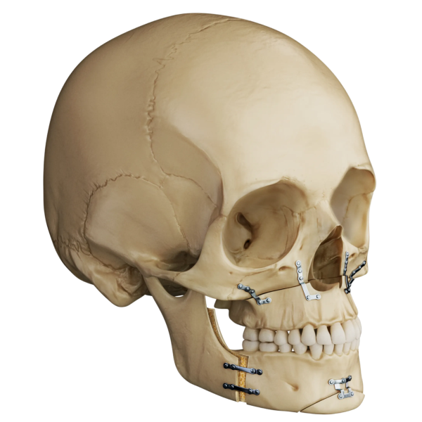 Double Jaw - after Double Jaw Surgery Result Illustration