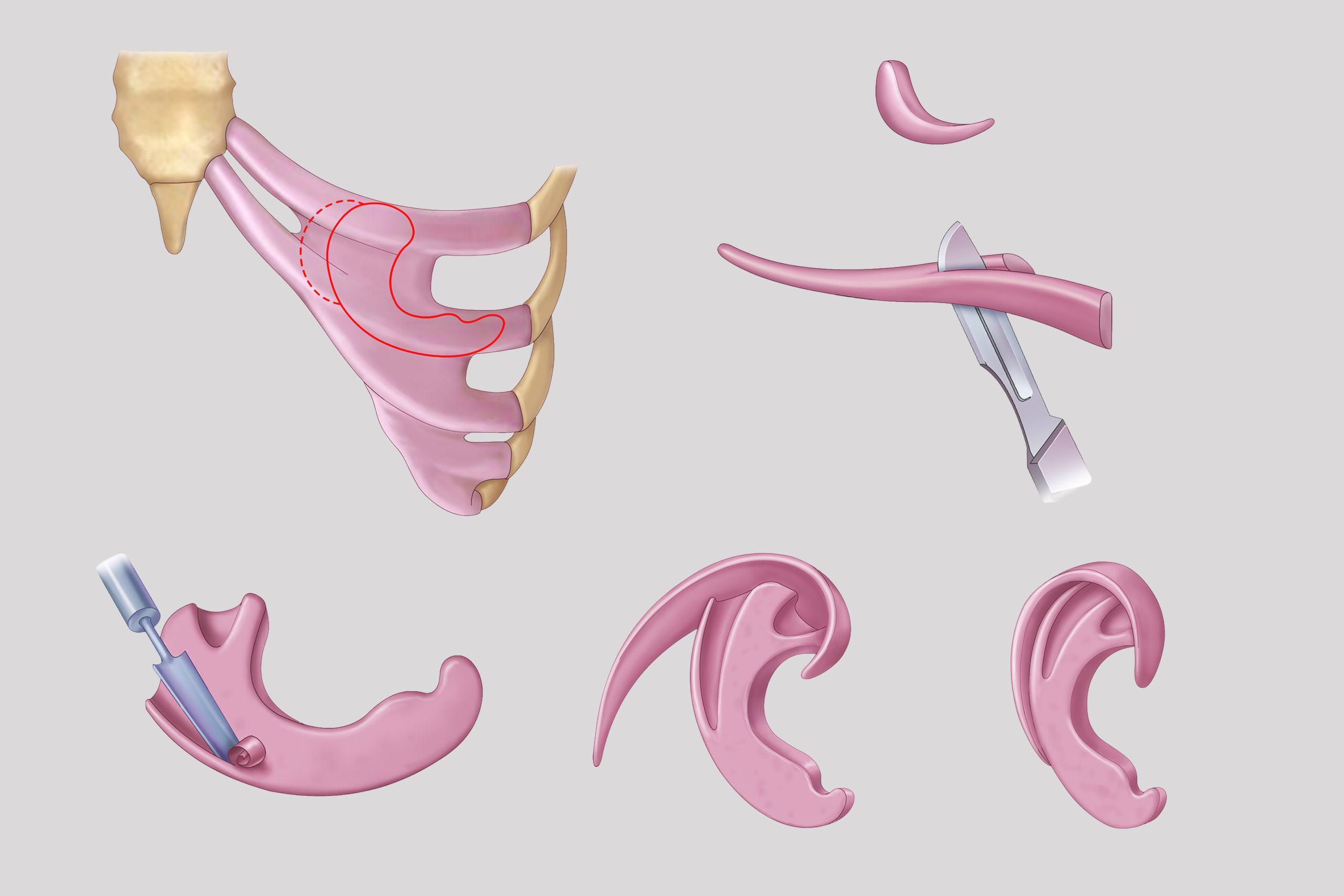 Illustration of staged ear reconstruction for microtia.