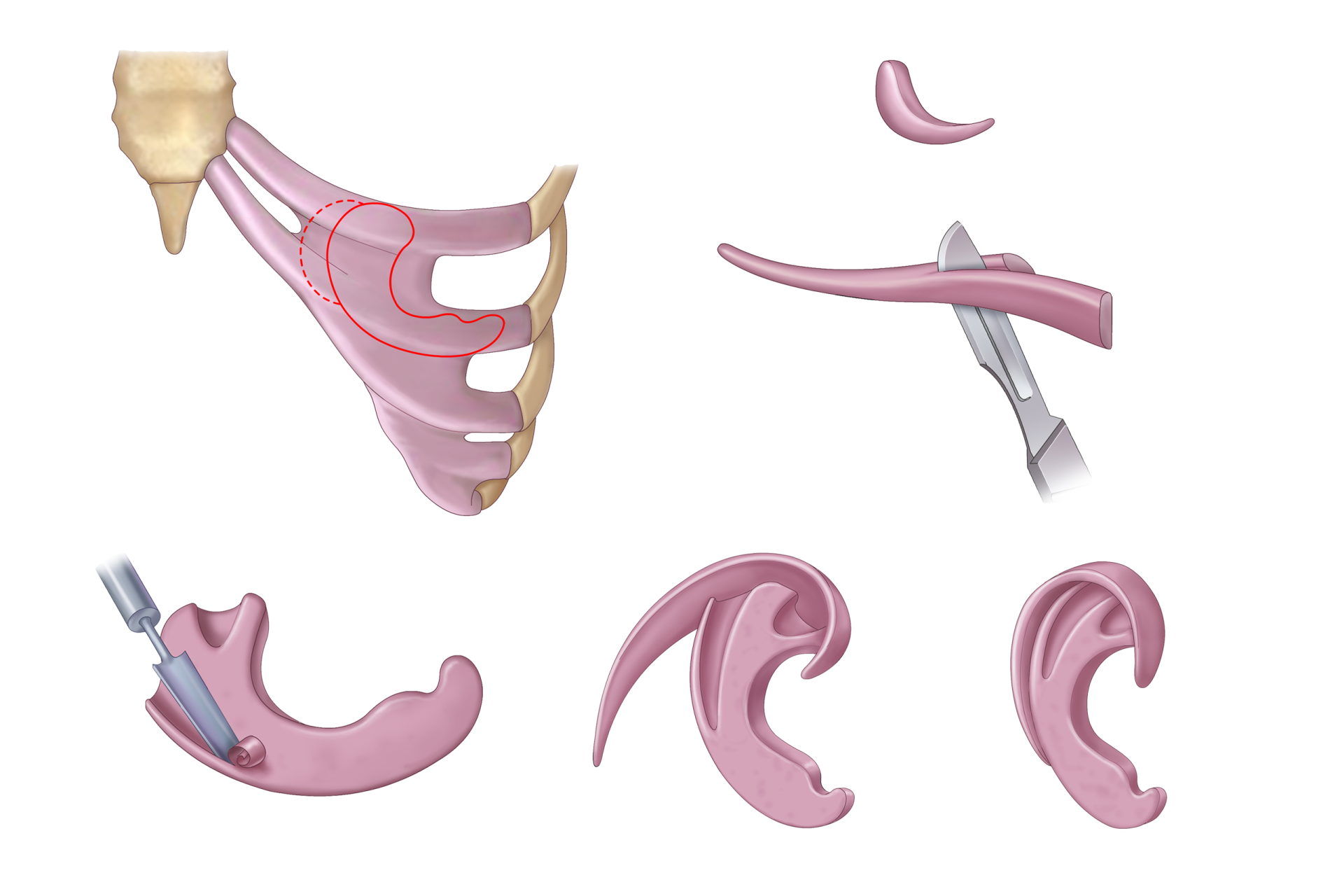 Illustration of surgical procedures for hemifacial microsomia correction.