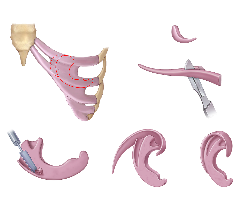 Detailed illustration of hemifacial microsomia affecting facial bones and tissues.