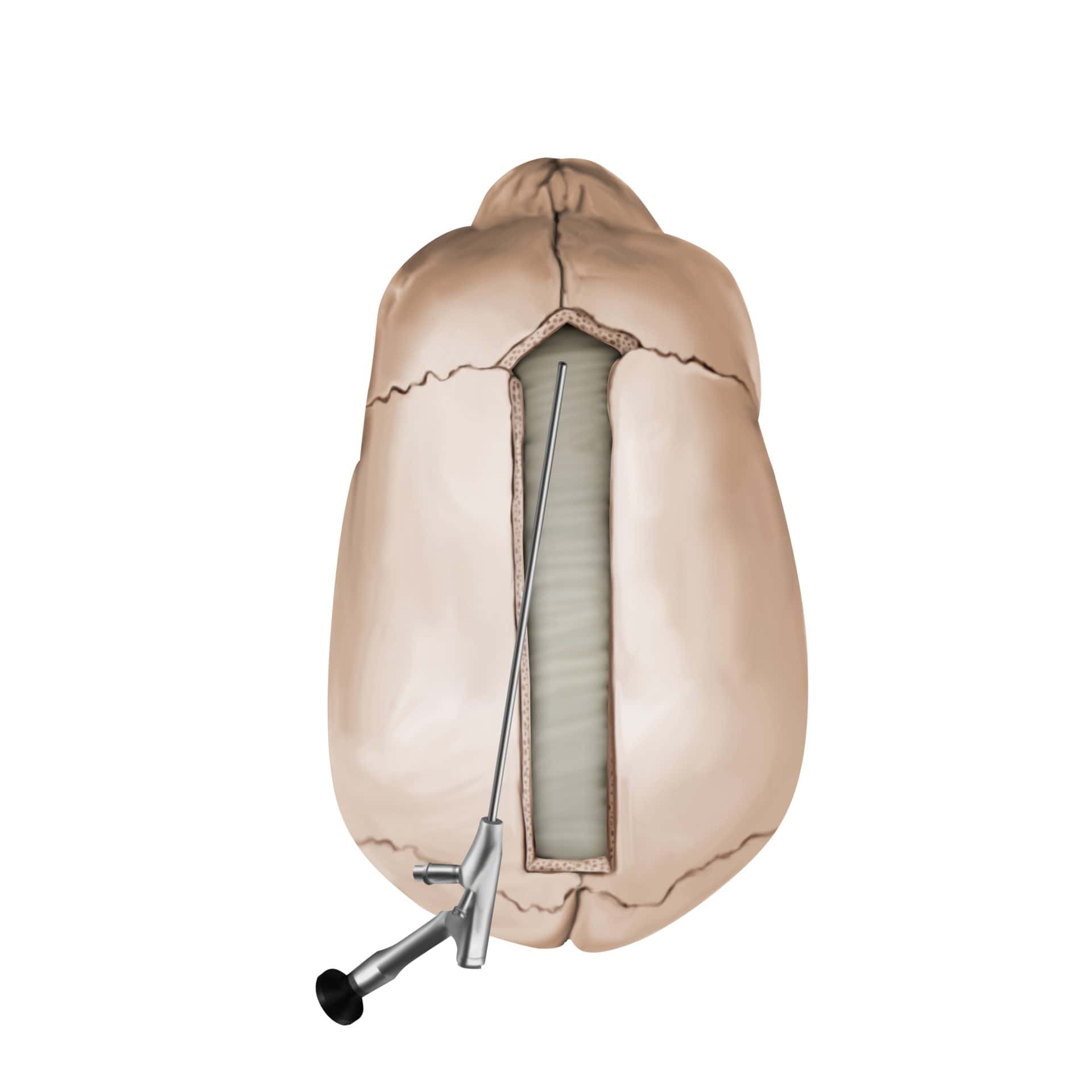 endoscopic-suturectomy-illustration.jpg