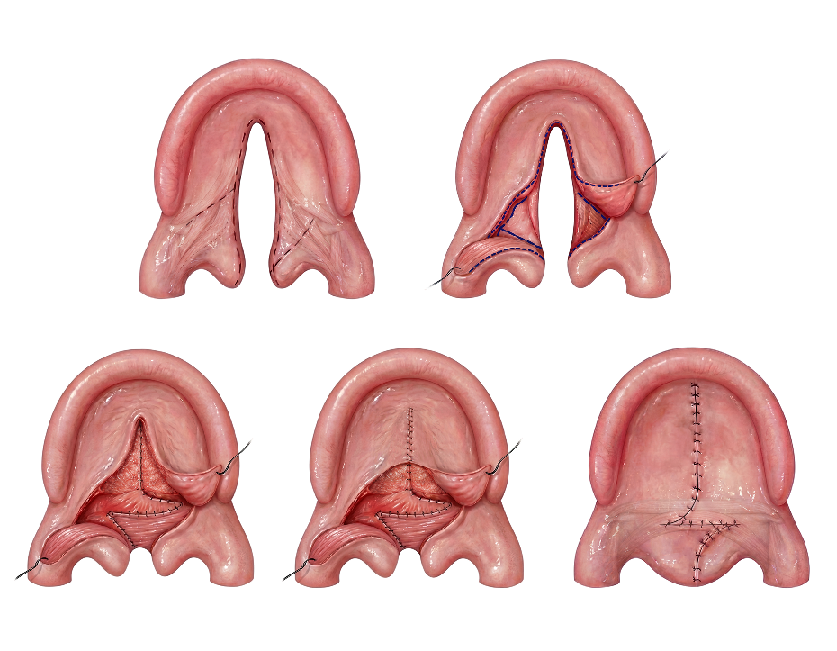 Illustration of 5 stages of a Furlow repair for cleft palate.