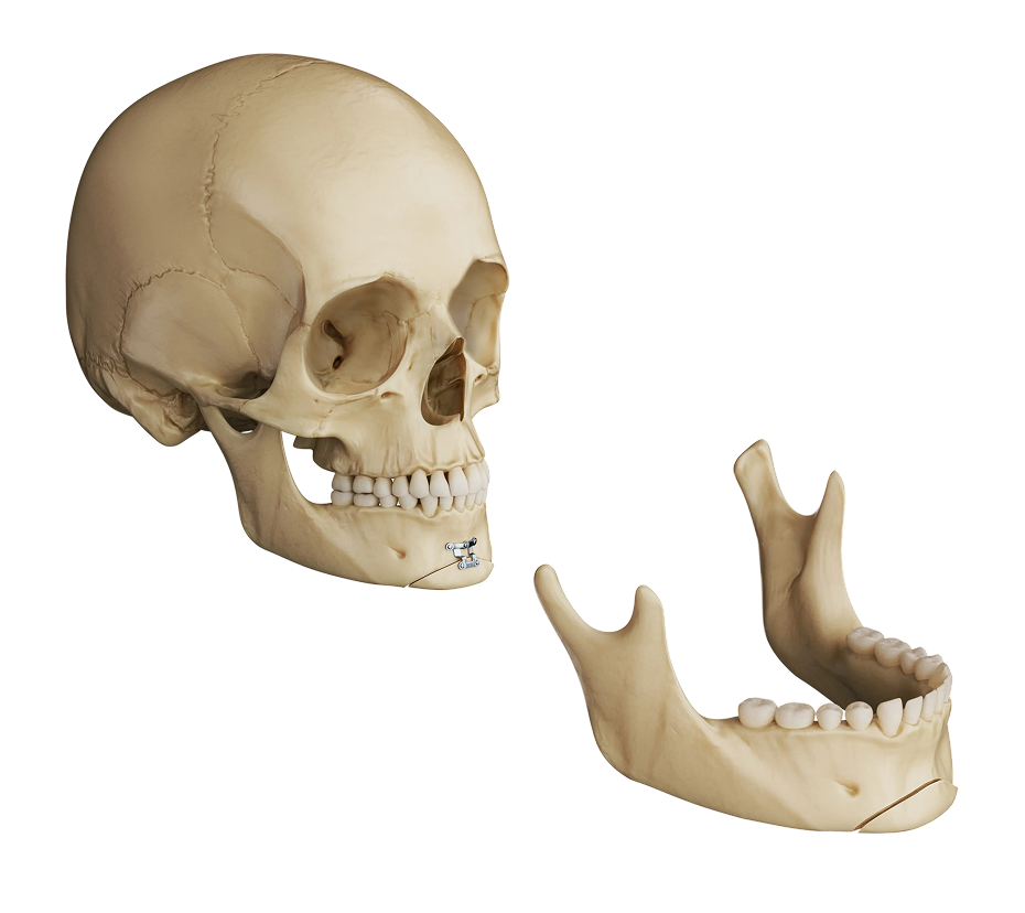 Illustration of genioplasty reshaping and repositioning the chin.