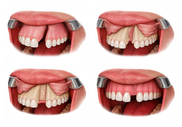 Grafting of an Alveolar Bone Cleft Illustration Series Series of illustrations showing grafting of an alveolar bone cleft.