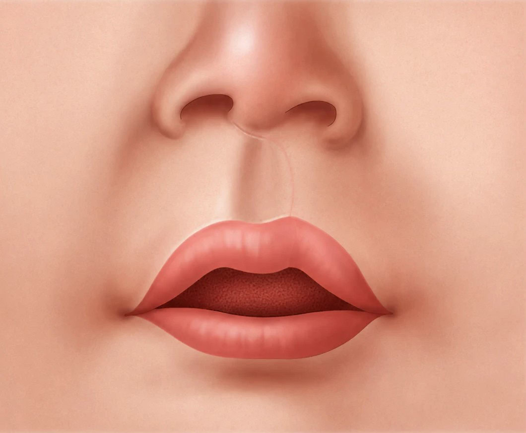 Unilateral-Cleft-Lip-Repair-step-4-healed-V3 Illustration of the healed, symmetric lip after unilateral cleft lip repair.