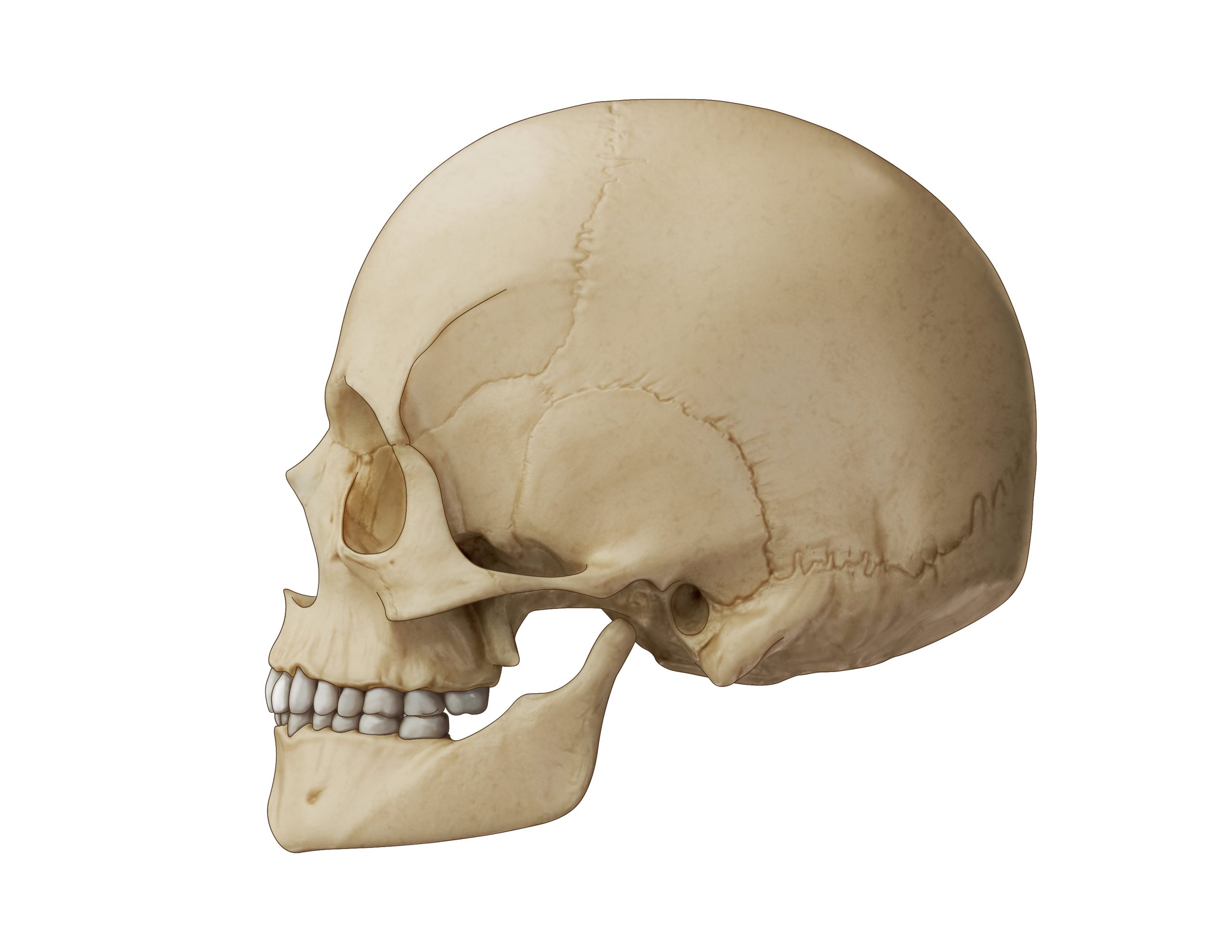Illustration of hemifacial microsomia with a type 2A mandible.