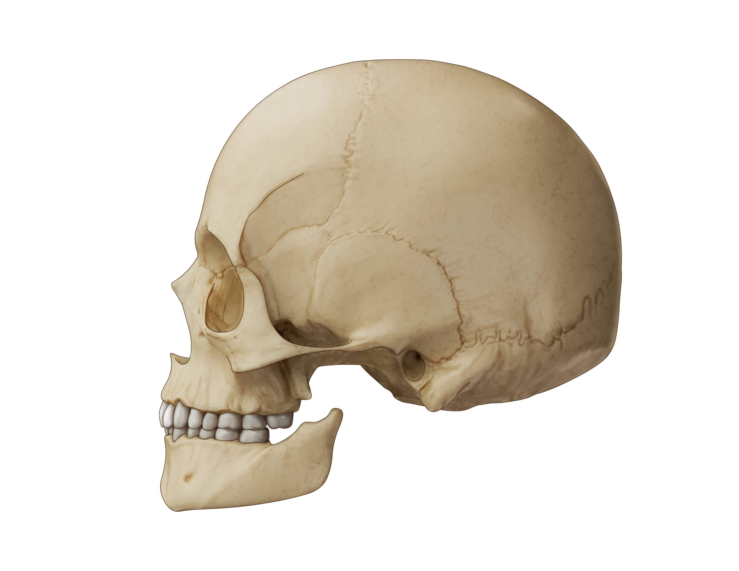 Illustration of hemifacial microsomia with a type 2B mandible.