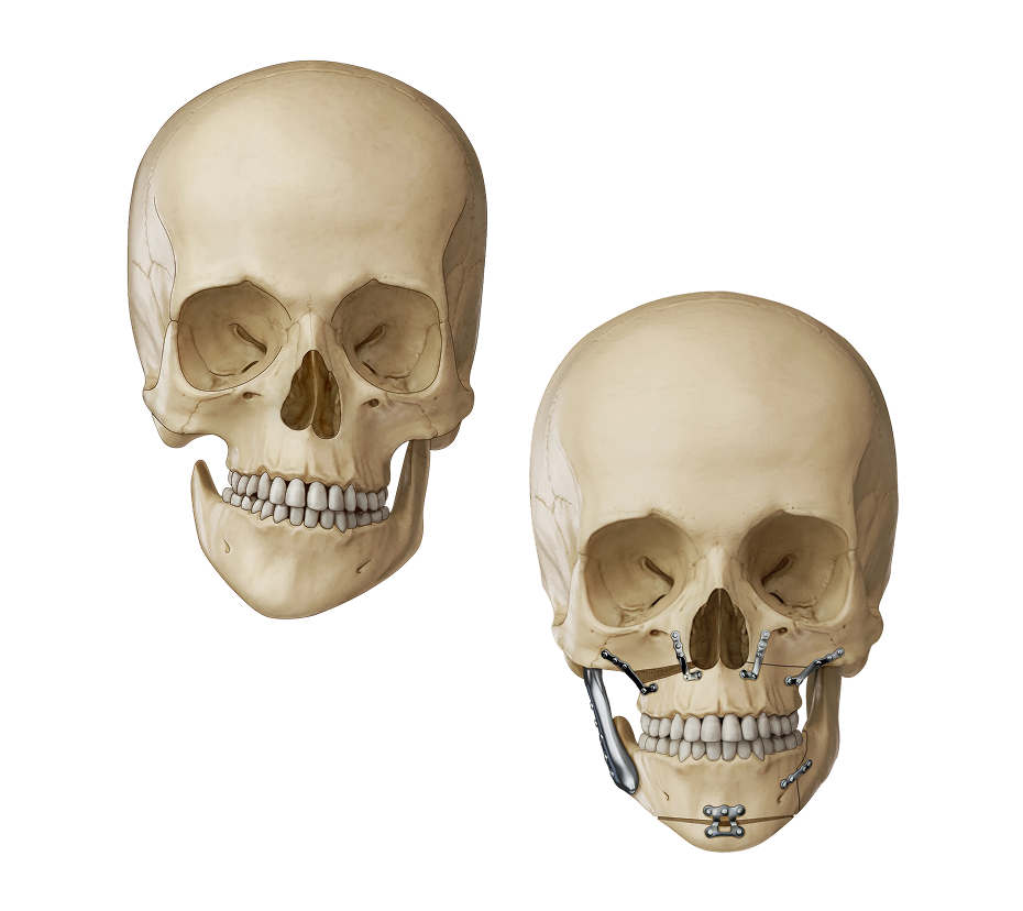 Illustration of severe hemifacial microsomia correction.