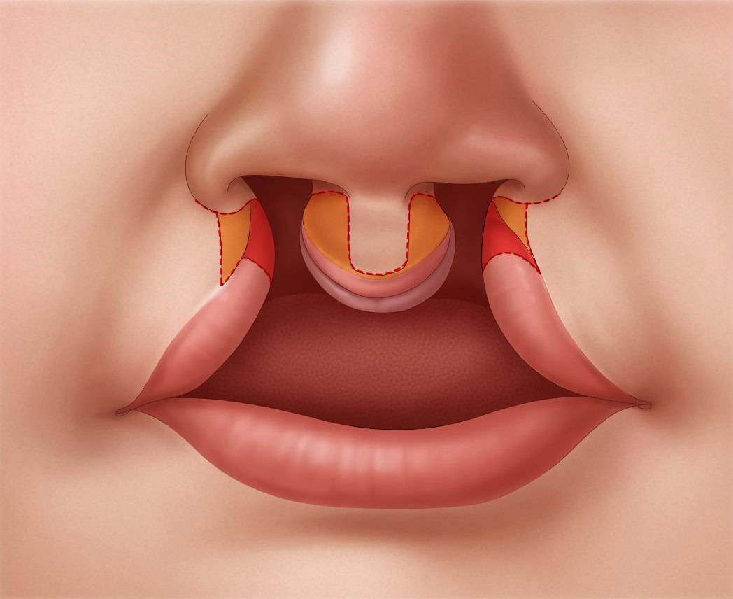 Bilateral-Cleft-Lip-Repair-step-2v2 Illustration of incision marking on both sides of the cleft in bilateral cleft lip repair.