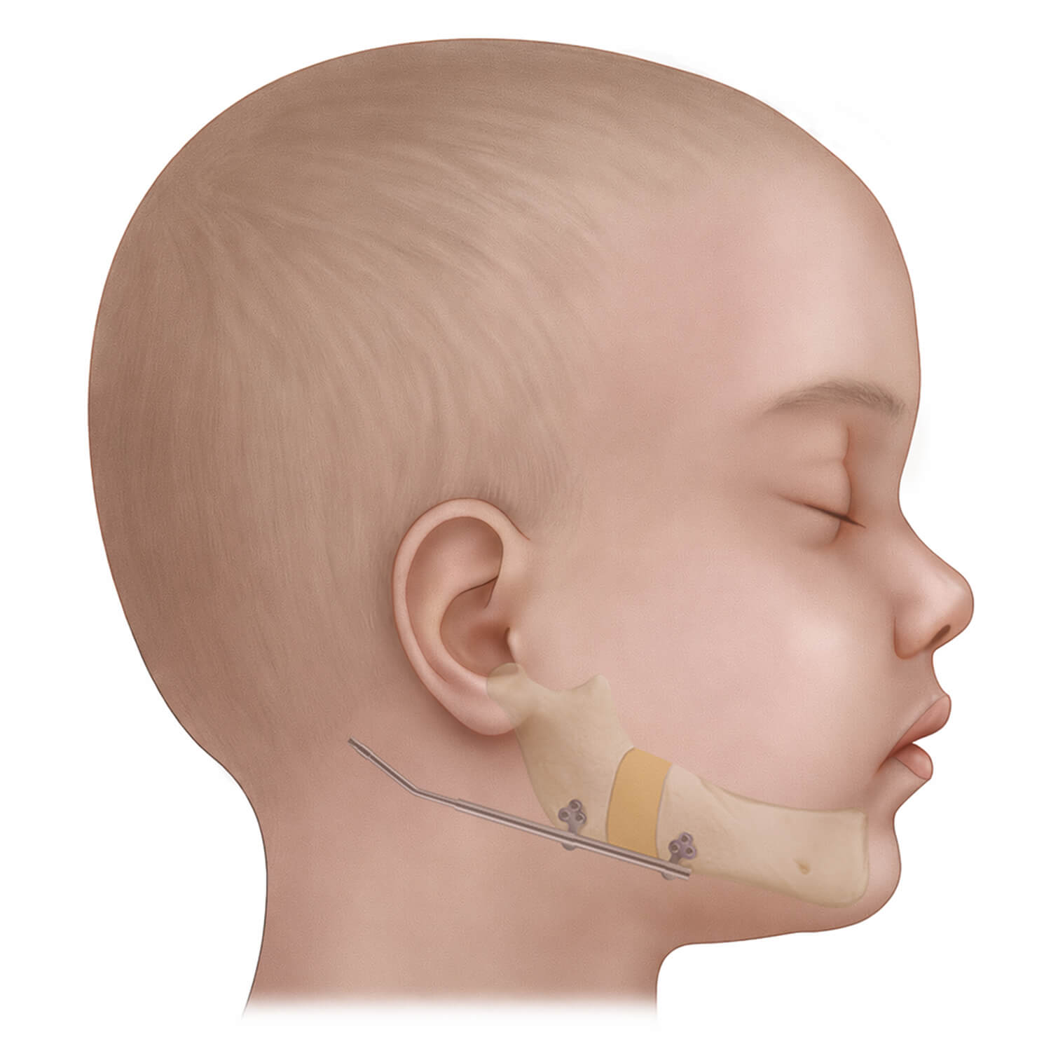 PRS_3-edited-scaled Illustration of gradual jaw lengthening with the distraction device in Pierre Robin Sequence treatment.