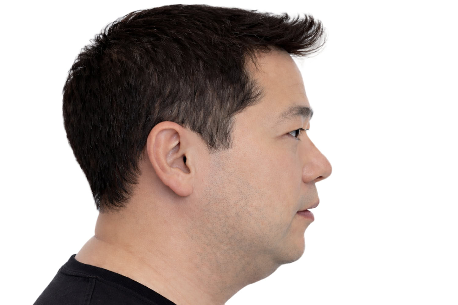 sleep-apnea-profile view-v3-upscaled Clinical presentation profile view of a patient associated with jaw-related obstructive sleep apnea.