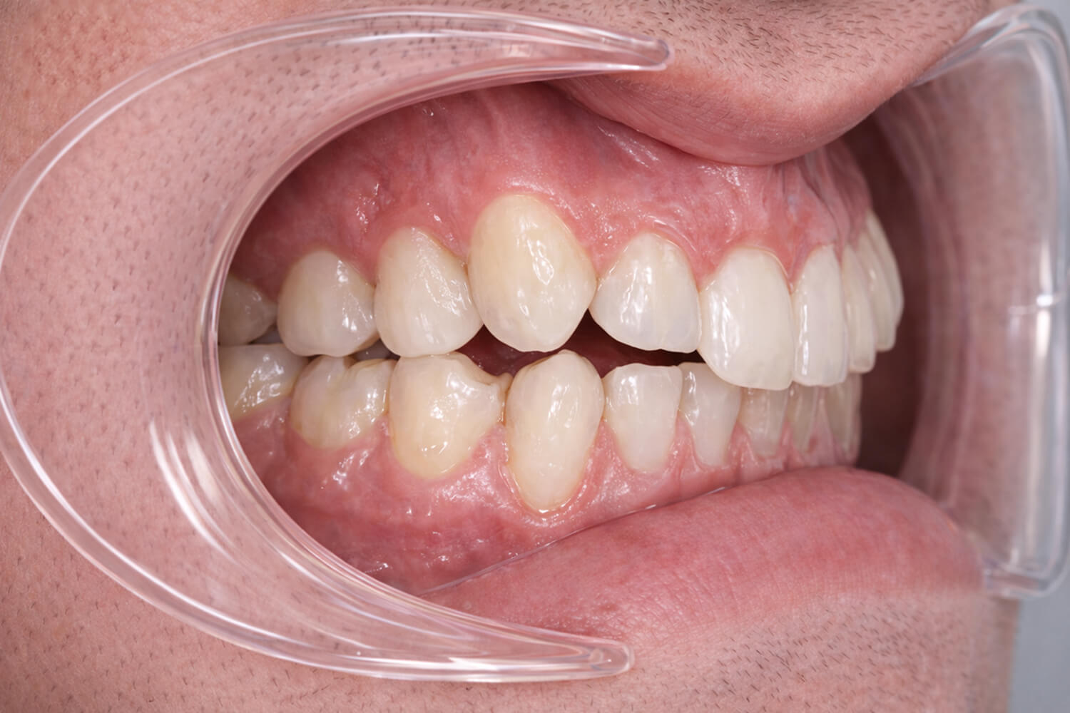 sleep-apnea-occlusal view-v4 (1) Clinical presentation associated with jaw-related obstructive sleep apnea.
