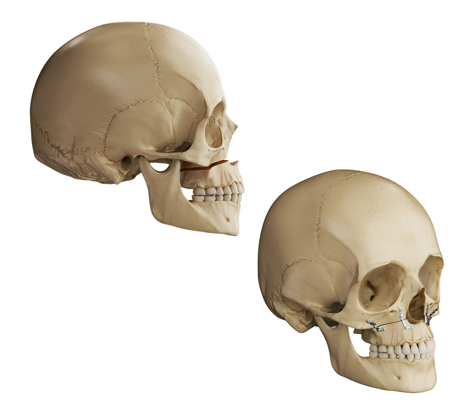 Le Fort I Osteotomy Illustration