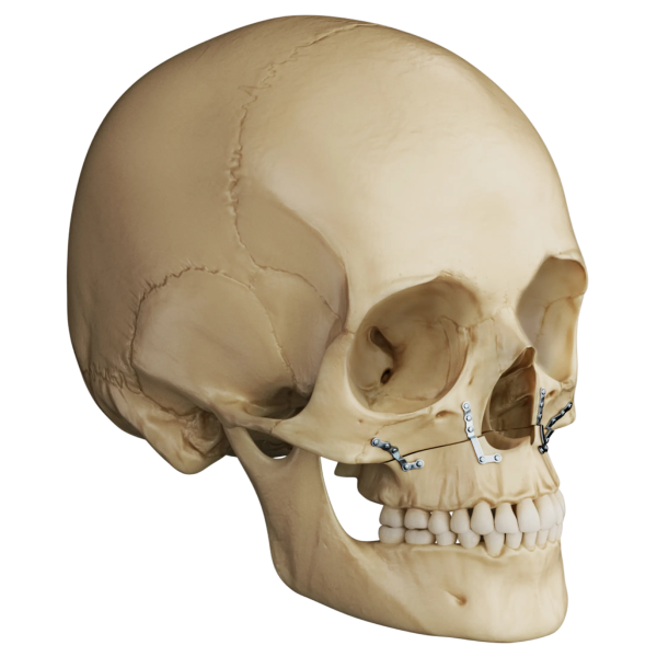 Lefort I - after Le Fort I Osteotomy Result Illustration